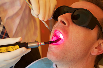 Low Level Laser Therapy LLLT Oral Mucositis