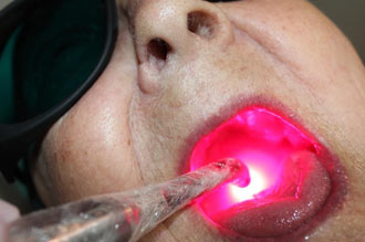Photobiomodulation (PBM) / Low Level Laser Therapy (LLLT) oral mucositis